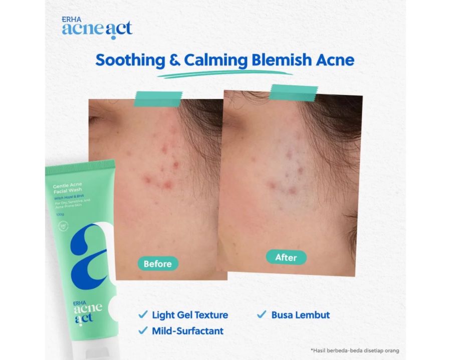 Erha Acneact Wh Gentle Acne Facial Wash 100gram