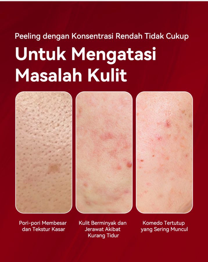 Focalskins Acids Essence Peeling Solution Serum Wajah 30ml