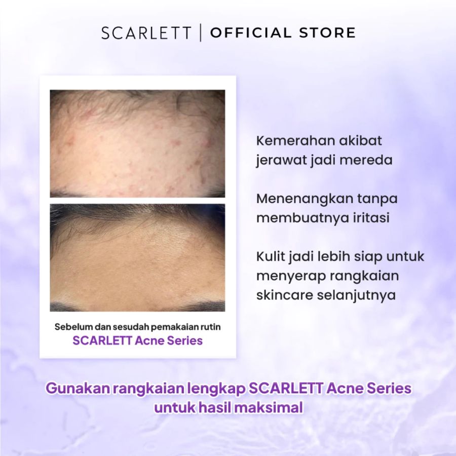Scarlett Acne Essence Toner 100ml
