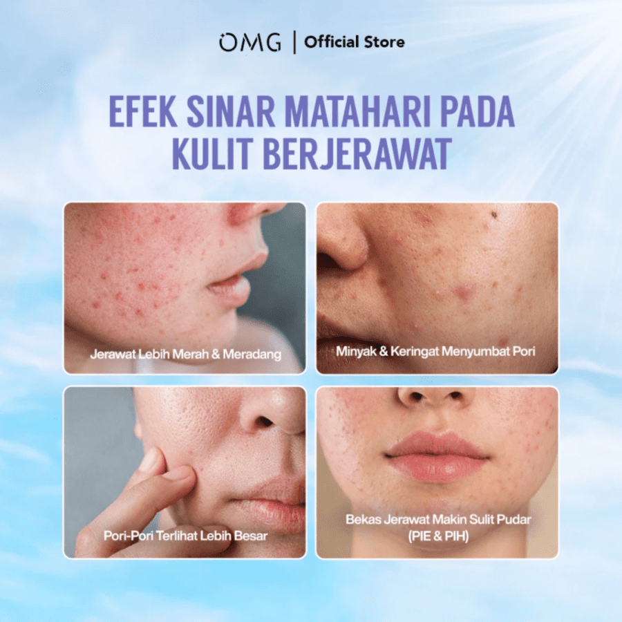OMG Oh My Glow Acne & Oil Control UV Barrier Sunscreen SPF50 PA++++ 
