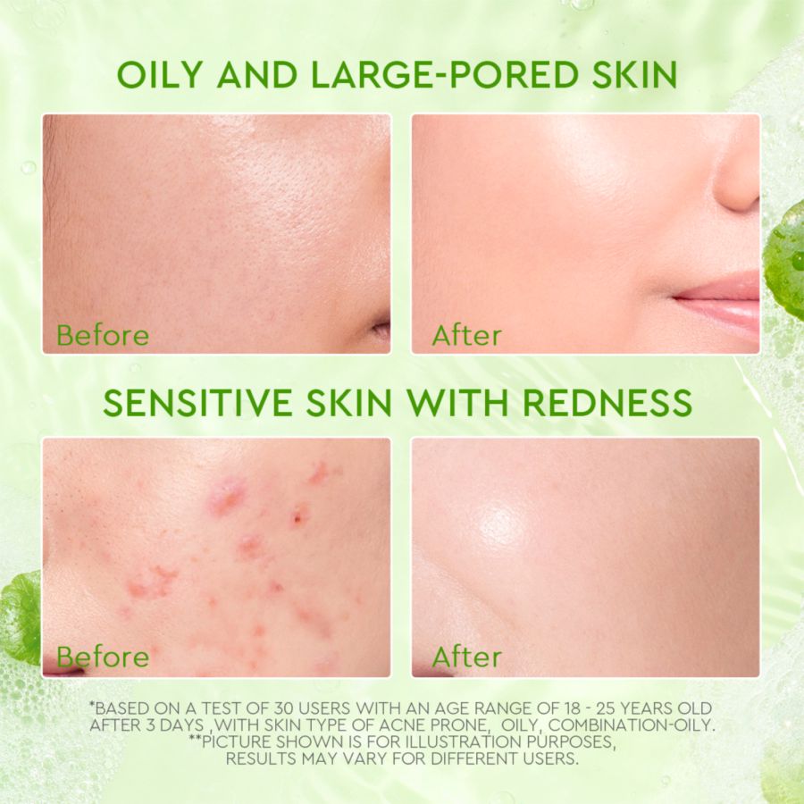 Glad2Glow Centella Salicylic Acid Acne Gel Cleanser Facial Wash 70ml