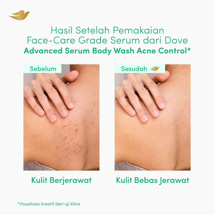 Dove Advanced Serum Acne Control Body Wash 300gram