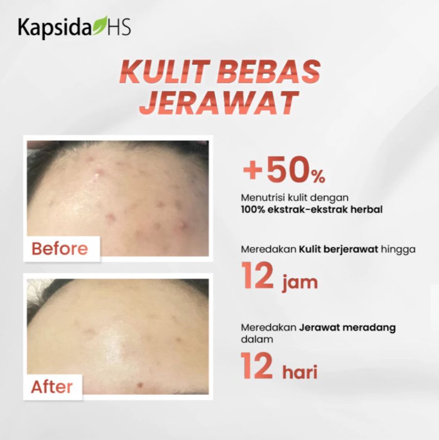 Kapsida HS Obat Gatal dan Jerawat 12kapsul