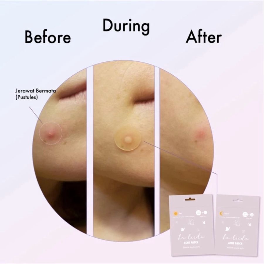 Kaleido Day Acne Patch