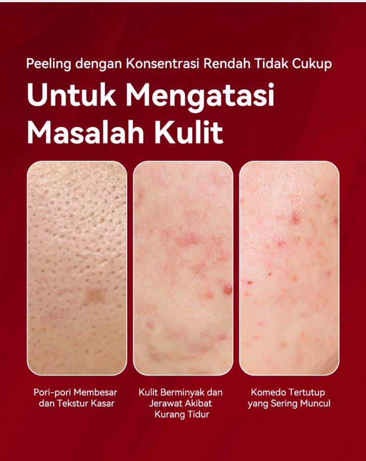 Focalskins Acids Essence Peeling Solution Serum Wajah 30ml