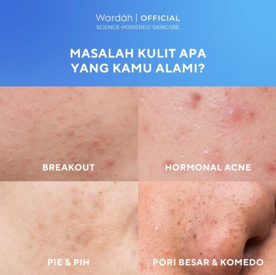 Wardah UV Shield Acne Calming Sunscreen Moisturizer SPF 35 PA+++