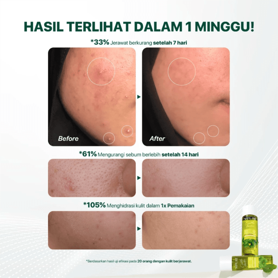 NPURE Cica Acne Foam Facial Wash 100ml